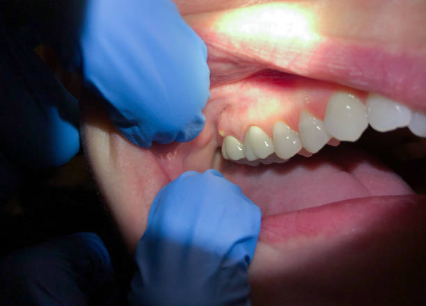 Best Emergency Denture Repair in Double Oak, TX