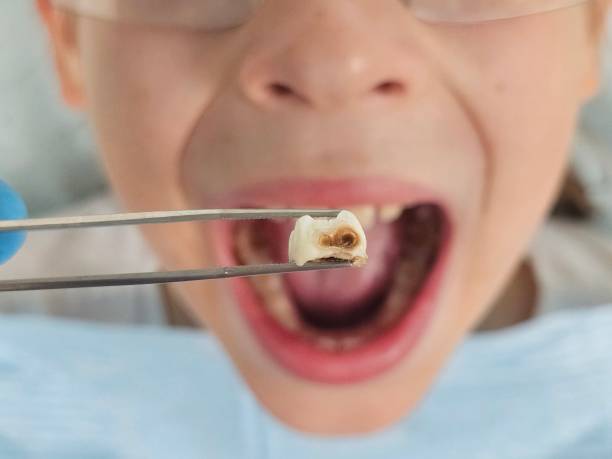 Best Emergency Treatment for Oral Infections in Double Oak, TX